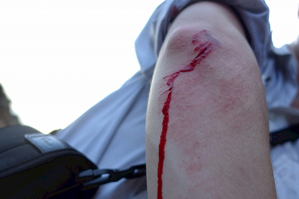 Close-up of bleeding elbow